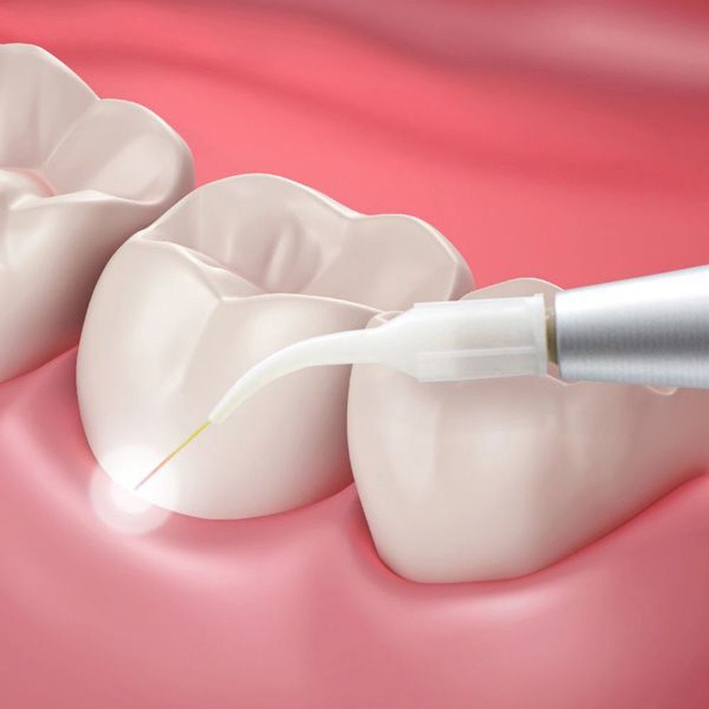 Periodontal treatment