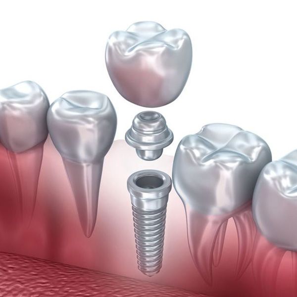 Dental implant